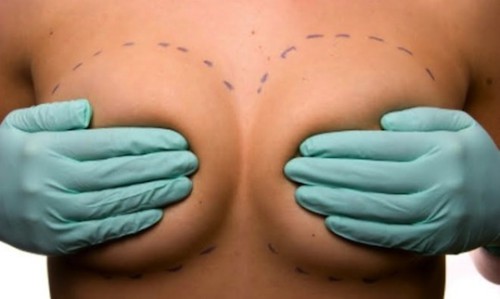 Breast-implant-surgery